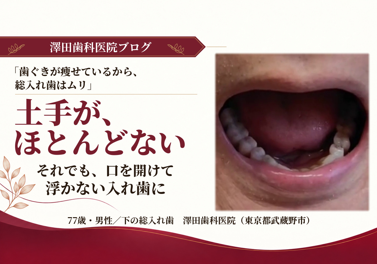 土手がほどんどない総入れ歯が開口しても浮かない
